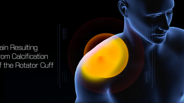 Pain resulting from Calcification in the Rotator Cuff