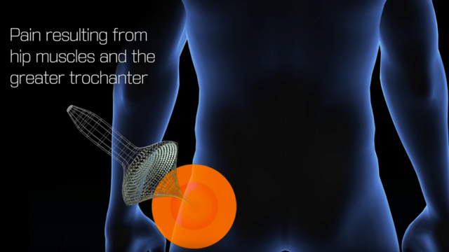 Hip Muscles and Greater Trochanter Pain