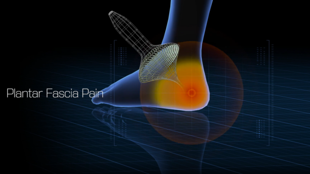 Plantar Fascia Pain